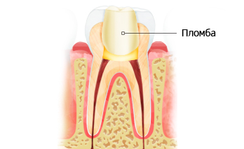 Почему болит зуб после пломбирования каналов: способы лечения и устранения боли5