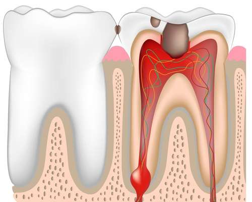Почему болит зуб после удаления нерва: причины, последствия5