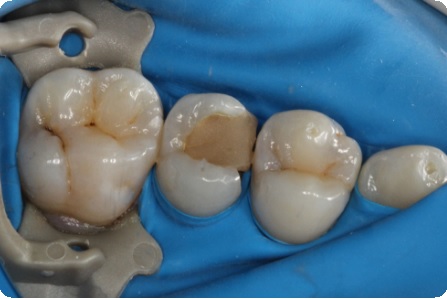 Почему болит зуб под пломбой: причины, диагностика, лечение5