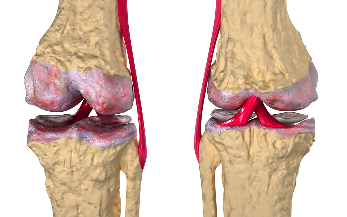 Артроз коленного сустава: лечение, симптомы, видео и фото, степени4