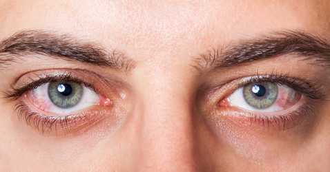 Синдром сухого глаза: симптомы, лечение, народные средства5