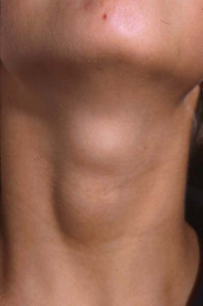 Киста щитовидной железы: лечение, правой и левой доли, фото, видео6