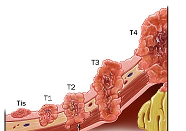 Рак желудка: симптомы, лечение, 1,2,3,4 стадии6
