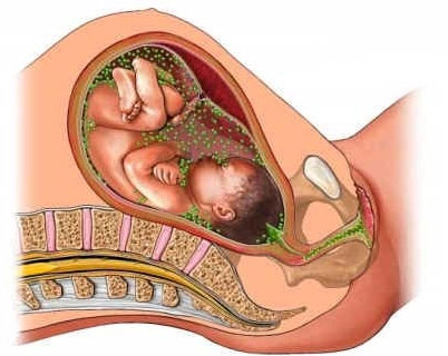 Инфекции при беременности. Оценка эффективности лечения6