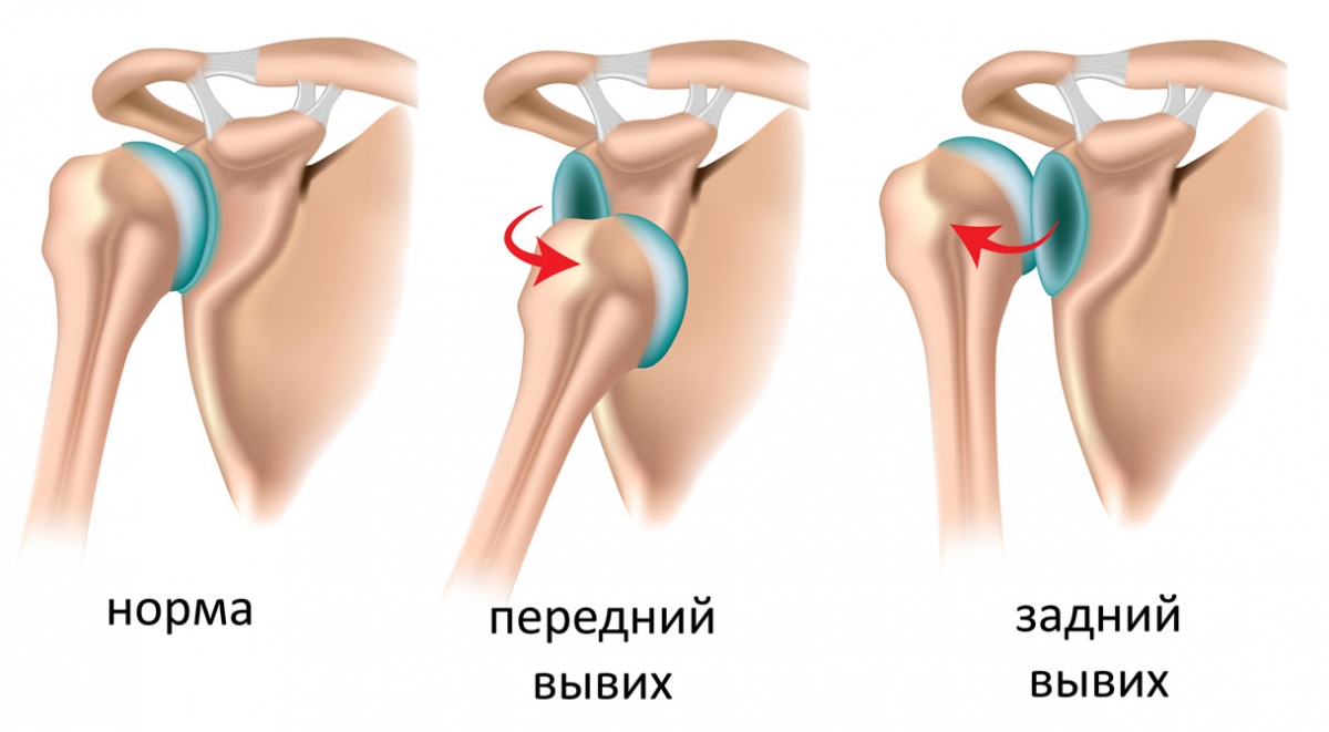 Перелом или вывих или ушиб или растяжение6