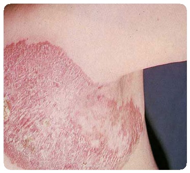 Туберкулез кожи: симптомы, признаки, лечение, фото6