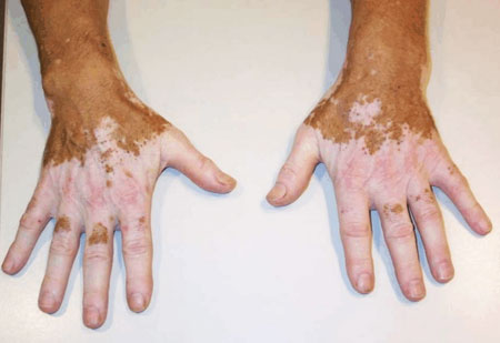 Нарушения пигментации кожи: причины, лечение, фото6