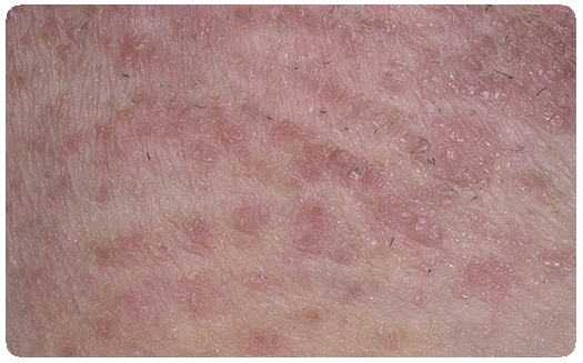 Острое воспаление кожи: виды, диагностика, лечение, фото6
