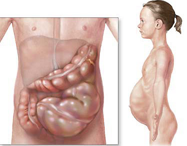 Пневмококковый перитонит у детей: симптомы, причины, лечение, осложнения6