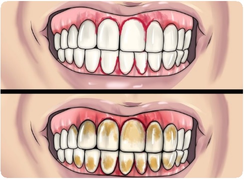 Химическое отбеливание зубов. Противопоказания к отбеливанию зубов6
