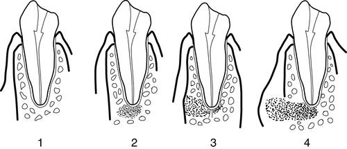 Реплантация зуба. Методики эндодонтического лечения зубов после травмы6