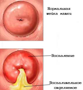 Гипоплазия матки: степени, лечение, симптомы, фото6