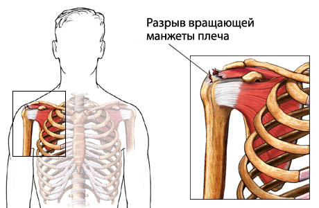 Боль в плечевом суставе: симптомы, лечение, причины, дискомфорт при поднятии руки6