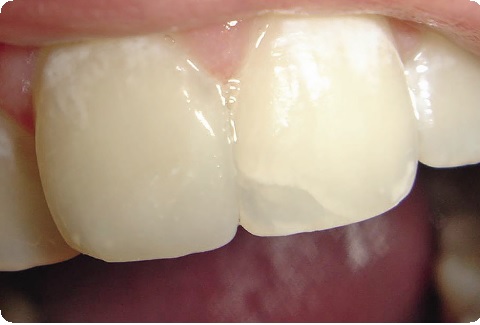 Почему болит зуб под пломбой: причины, диагностика, лечение6