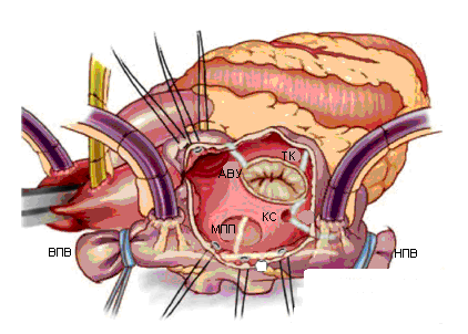 Стеноз аортального клапана: лечение, операция6
