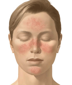 Угревая сыпь: лечение ботулотоксином, последствия, отзывы, фото6