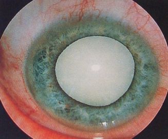 Катаракта глаз: симптомы, лечение, причины, операции, профилактика6