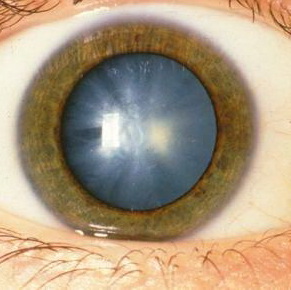 Катаракта глаз: симптомы, лечение, причины, операции, профилактика7