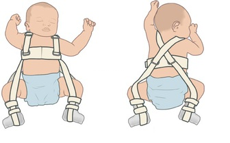 Дисплазия тазобедренного сустава у новорожденных: лечение, фото и ведео  7