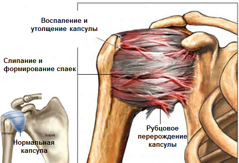 Боль в плечевом суставе: симптомы, лечение, причины, дискомфорт при поднятии руки7