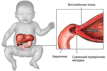Пневмококковый перитонит у детей: симптомы, причины, лечение, осложнения7