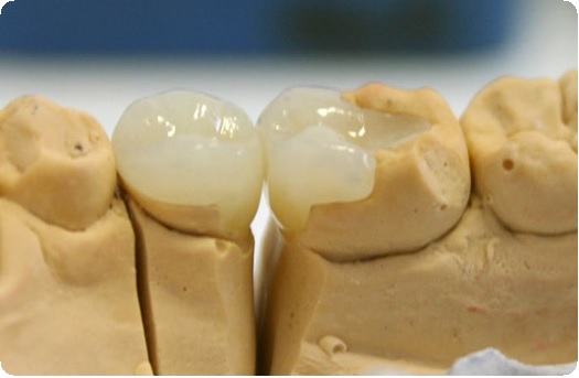 Перелом корня зуба: лечение, методики терапии7