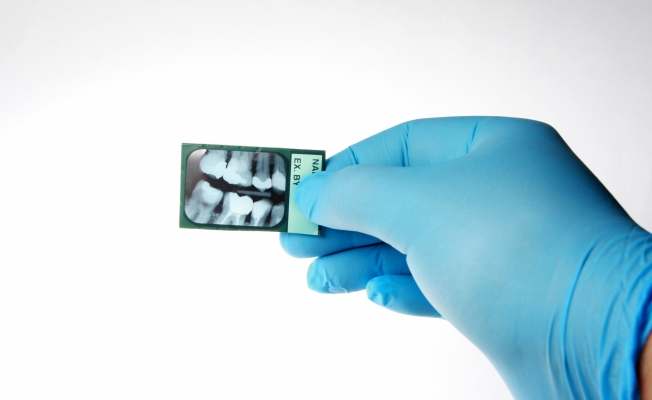 Реплантация зуба. Методики эндодонтического лечения зубов после травмы7