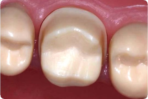Препарирование зуба: показания, этапы, методы, последствия7