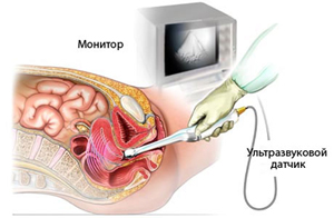 Гипоплазия матки: степени, лечение, симптомы, фото7