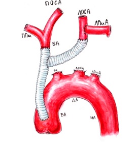 Коарктация аорты: операция, этапы, последствия7