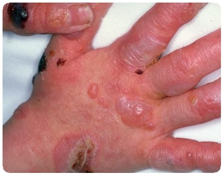 Врожденный сифилис: признаки, проявления. Сифилис плода8