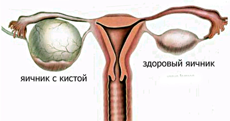 Беременность после лапароскопии 8
