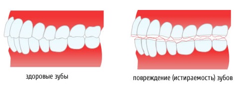 Химическое отбеливание зубов. Противопоказания к отбеливанию зубов8