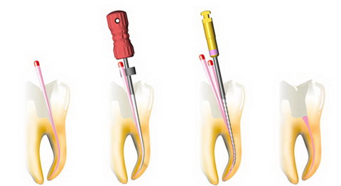 Реплантация зуба. Методики эндодонтического лечения зубов после травмы8