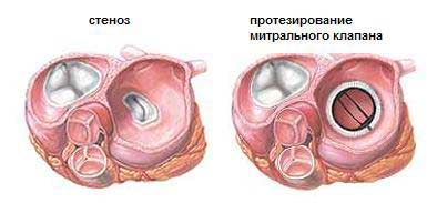 Клапанный стеноз аорты: диагностика, лечение, рекомендации врачей8