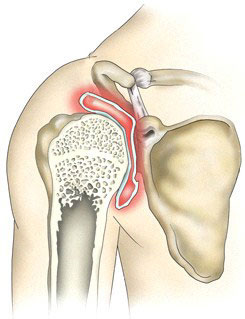 Боль в плечевом суставе: симптомы, лечение, причины, дискомфорт при поднятии руки8