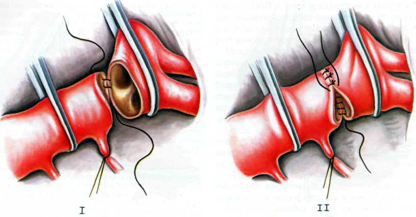 Коарктация аорты: операция, этапы, последствия8