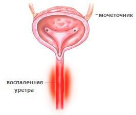 Хламидиоз у мужчин: симптомы, лечение8