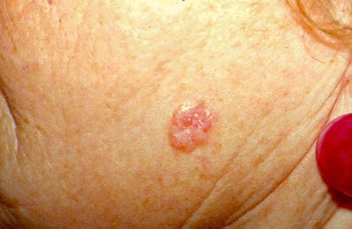 Рак кожи, начальная стадия: фото8