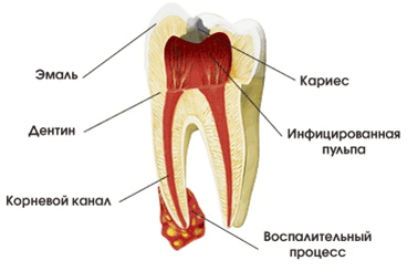 Лечение временных зубов. Некроз пульпы 8