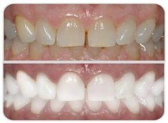 Химическое отбеливание зубов. Противопоказания к отбеливанию зубов9
