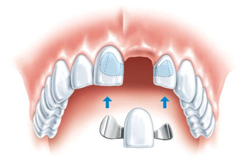 Перелом корня зуба: лечение, методики терапии9