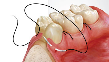 Микрохирургия в стоматологии: показания, этапы, последствия9