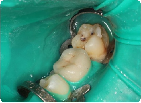 Препарирование зуба: показания, этапы, методы, последствия9