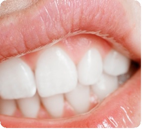 Ретенция зуба и другие дополнительные меры при реставрации9