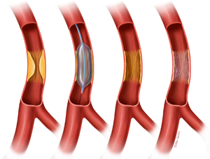 Порок клапана легочной артерии. Врожденный порок КЛА9