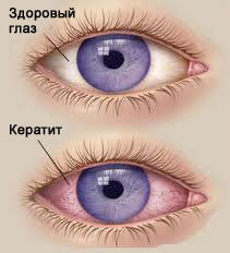 Ухудшение зрения: симптомы, причины, лечение, что делать. Категория болезни глаз. 9