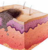 Рак кожи, начальная стадия