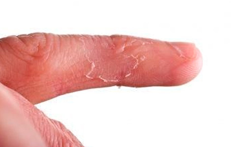 дерматит палец