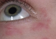Аллергия вокруг глаз 